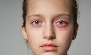 Czerwone, opuchnięte oczy i spierzchnięte usta u dziecka to wyraźne objawy alergii.