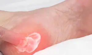 Jakie leki na ostrogę piętową pomogą w bólu i zapaleniu?