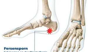 Knochenmodell eines Fußes mit hervorgehobenem Fersensporn hinten, der Schmerzen an der Plantarfaszie verursacht.