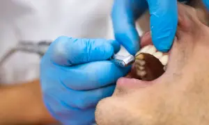 Dentysta w niebieskich rękawiczkach używa wiertła stomatologicznego do leczenia zęba, który może być dotknięty zatruciem.