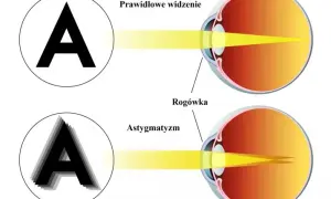Astygmatyzm: Jak skutecznie korygować i trwale usunąć wadę?