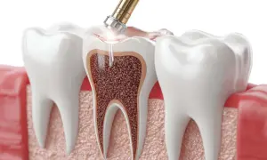 Model zęba w przekroju, gdzie narzędzie dentystyczne wykonuje leczenie kanałowe. Choć procedura jest skuteczna, warto pamiętać o potencjalnych skutkach ubocznych leczenia kanałowego.
