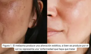 Comparación de piel con melasma y piel tratada. Descubre pastillas para quitar melasma y mejorar tu rostro.
