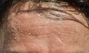 Frente sudorosa, con gotas de agua brillando. Busca trucos para no sudar por la cabeza y mantenerte fresco.