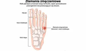 Anatomia stopy z zaznaczonym złamaniem zmęczeniowym 5. kości śródstopia.