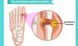 Ilustracja przedstawia staw palucha z kryształami kwasu moczowego, co jest przyczyną artretyzmu.