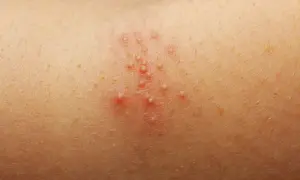 Skóra dorosłego z zaczerwienieniem i skupiskiem małych pęcherzyków, objaw potówki.