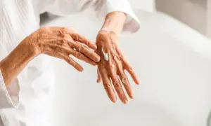 Delikatne pomarańczowe plamy na dłoniach starszej osoby, która nakłada krem. Skóra dłoni jest pomarszczona, ale zadbana.