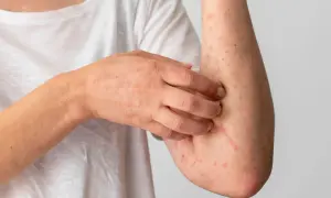 A person scratches an arm covered in red, itchy bumps, possibly indicating acaros en el colchon sintomas.