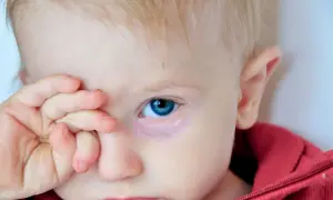 Niemowlę z niebieskimi oczami i sine powieki, zasłaniające jedno oko dłonią.