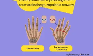 Porównanie zdrowych stawów dłoni z zaawansowanym stadium RZS, gdzie widoczne są zmiany zapalne i uszkodzenia kości.