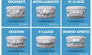 Modelli di denti con problemi: crossbite, affollamento, III classe, diastemi, II classe, morso aperto. Soluzioni Invisalign per correggere.