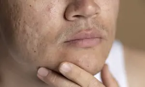 Primer plano de un rostro masculino con marcas de acné visibles en la mejilla y la barbilla.