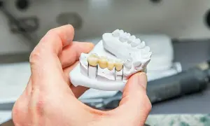 Model szczęki z widocznym, wykonanym z porcelany mostkiem na zębach.