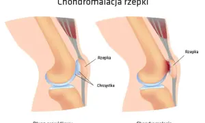 Ilustracja porównująca prawidłowe kolano z kolanem z chondromalacją rzepki.