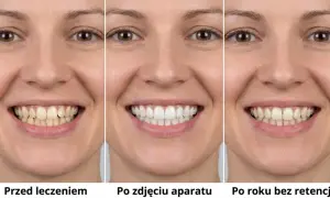 Uśmiech przed leczeniem, po zdjęciu aparatu stałego i po roku bez retencji. Widać znaczącą poprawę.
