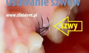 Zdjęcie szwów u dentysty: Koszt, NFZ i jak zaoszczędzić?