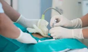 Lekarze w rękawiczkach wykonują amniopunkcję, pobierając płyn owodniowy do badań.