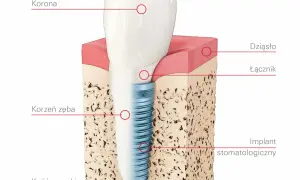 Co to jest implant zęba? Wszystko, co musisz wiedzieć o korzyściach i procesie implantacji