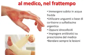 Mano ustionata e piede fasciato. Cosa mettere sulle scottature: acqua fredda, unguenti, idrocolloidi o antibiotici su prescrizione.
