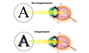 Jak astygmatyk widzi litery? Wyjaśniamy objawy i korekcję