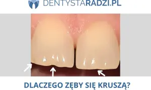 Zbliżenie na dwa zęby z widocznymi ubytkami na krawędziach, wskazującymi na ukruszone szkliwo. Strzałki podkreślają problem.