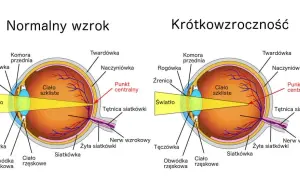 Krótkowzroczność: przyczyny, objawy i jak chronić wzrok?