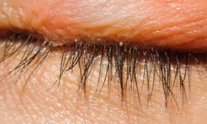Nahaufnahme des menschlichen Augenlids mit Wimpern. Kleine, helle Punkte, die wie Milben am Auge aussehen, sind auf den Wimpern und der Haut sichtbar.