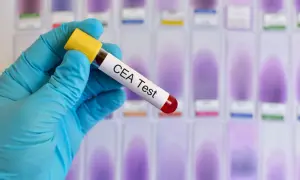 Rękawiczka trzyma probówkę z napisem "CEA Test". W tle widać rząd szkiełek mikroskopowych z fioletowymi plamami.