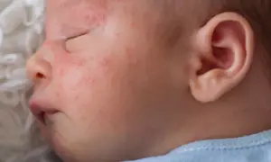 Alergia na BMK u niemowlaka: Objawy, które musisz znać!