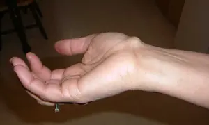 Poignet gauche avec un kyste synovial visible. Témoignages sur le kyste synovial poignet.