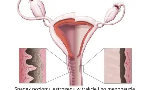 Ilustracja pokazuje, jak spadek estrogenu po menopauzie prowadzi do atrofii pochwy, powodując ścieńczenie i suchość jej ścianek.
