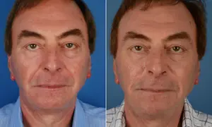 Mężczyzna przed i po zabiegu. Zmniejszone bruzdy nosowo-wargowe i poprawa owalu twarzy.