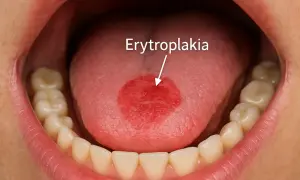 Czerwone plamy na języku, jedna z nich oznaczona jako erytroplakia, widoczna w jamie ustnej z zębami.