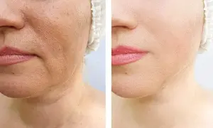 Confronto pelle: pori dilatati prima e dopo, con un visibile miglioramento della texture e della compattezza.