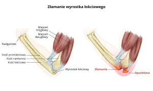 Ilustracja anatomiczna łokcia: zdrowy staw i złamanie wyrostka łokciowego z obrzękiem.