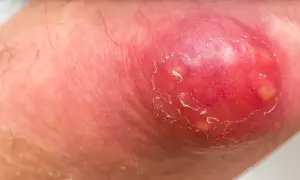 Rote, entzündete Haut mit einem aufgeplatzten Abszess. Die Haut schuppt und ist gereizt. Was nun?