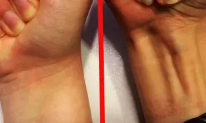 Vergleich zweier Handgelenke: Links glatt, rechts mit sichtbaren Sehnen, darunter der palmaris longus.