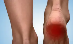 Ból pięty, zaczerwienienie i widoczne naderwanie rozcięgna podeszwowego.