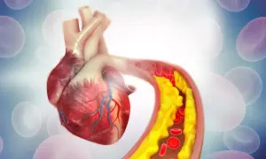 Serce i tętnica z cholesterolem nie-HDL. Żółte złogi blokują przepływ krwi, zagrażając zdrowiu.
