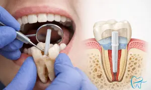 Dentysta wprowadza wkład koronowo-korzeniowy. Czy odbudowa zęba boli? Nowoczesne metody minimalizują dyskomfort.
