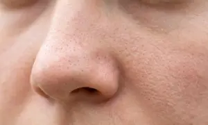 Primer plano de la piel de la nariz con poros obstruidos, mostrando la textura y pequeñas imperfecciones.