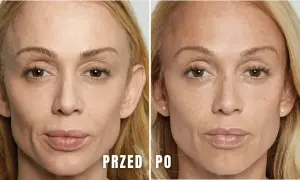 Przed i po zabiegu: skóra pod oczami wygładzona, zmarszczki zredukowane dzięki kwasowi polimlekowemu.