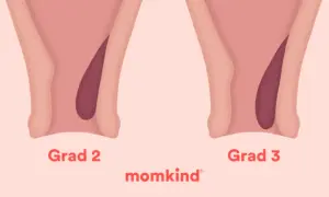 Illustration visar grader av hemorrojder, från grad 1 till 4. Vanligt vid graviditet.