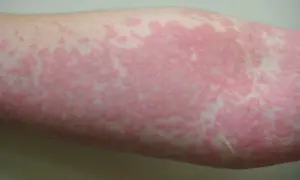 Brazo con ronchas en la piel sin picor, de color rosado y con un patrón irregular.