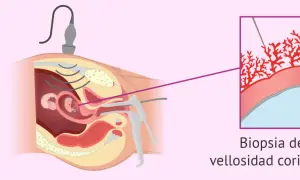 Ilustración de una biopsia corial guiada por ultrasonido, mostrando la toma de muestra de vellosidades coriónicas para análisis genético.