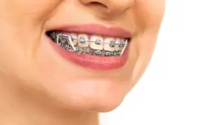 Primo piano di un sorriso con apparecchio ortodontico e elastici, simbolo di un percorso verso denti perfetti.
