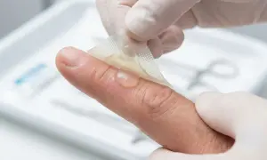 Eine kleine Brandblase am Finger wird vorsichtig mit einem transparenten Verband abgedeckt.