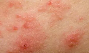 Czy pelargonie uczulają? Objawy alergii i bezpieczne odmiany