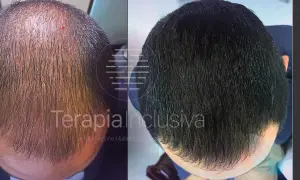 Prima e dopo: un uomo mostra come far ricrescere i capelli con un trattamento che ha ridensificato la chioma, eliminando la calvizie.